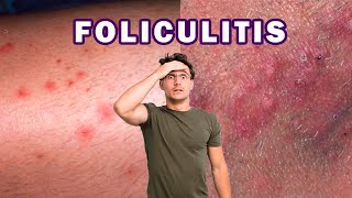 CÓMO ELIMINAR LA FOLICULITIS INFECCIOSA  BACTERIANA [upl. by Graces922]