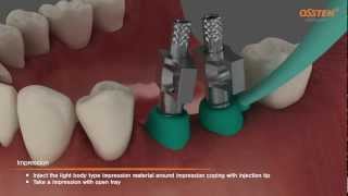 TSIII Fixture Placement amp Impression taking Pickup and Transfer Impression Copings [upl. by Abel]