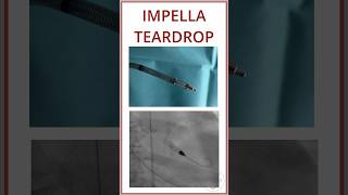 IMPELLA TEARDROP IN FLUOROSCOPY SCREW CONNECTION [upl. by Neilla110]