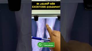 Bone tumour  Exostosis  Osteochondroma shorts bonecancer [upl. by Raybin]