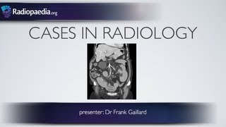 Cases in Radiology Episode 2 abdomen CT [upl. by Vincelette]