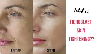 What is Fibroblast Skin Tightening [upl. by Schaffel]