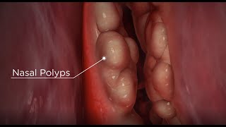 Nasal Polyps diagnosis and treatment options [upl. by Daley]