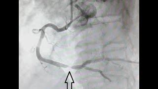 Cateterismo ou Arteriografia Seguida de Angioplastia com stent [upl. by Tneicniv]