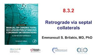 832 Manual of CTO PCI  Retrograde via septal collaterals [upl. by Mccreary]