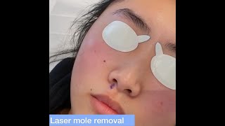 Laser Mole Removal  London Skin Clinic [upl. by Eidassac]