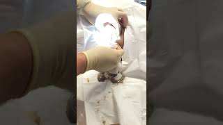 Exploding grapefruit sized sebaceous cyst popping [upl. by Nevanod]