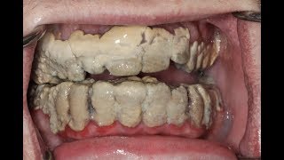 20 Years Without Brushing Teeth 😦  Calculus Removal [upl. by Seta123]