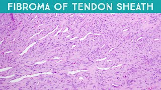 Fibroma of tendon sheath explained in 5 minutes finger mass dermpath soft tissue tumor pathology [upl. by Idna]