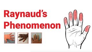 Raynaud’s Phenomenon  What You Should Know  Johns Hopkins Medicine [upl. by Eedoj310]