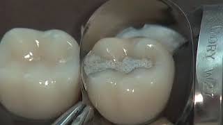 Class II Amalgam Preparation amp Restoration  Operative Dentistry [upl. by Philippe]