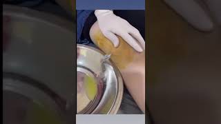 Draining fluid from knee [upl. by Schluter905]