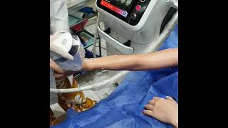 Advanced high speed laser hair removal using the Germanmade Mediostar machine [upl. by Brion]