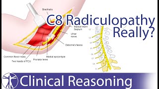 Ulnar Nerve Entrapment mimicking C8 Radiculopathy [upl. by Chelton]