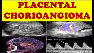 placental chorioangioma [upl. by Tonie]