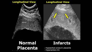 Placenta Ultrasound Normal Vs Abnormal Image Appearances Comparison  Placental Pathologies on USG [upl. by Marie-Ann]