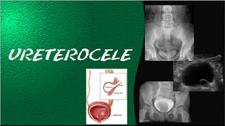 Videoaula e dicas em RADIOLOGIA  ultrassonografia urografia excretora e cistografia  Ureterocele [upl. by Vaules]