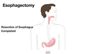 HCC 147510a  Surgical Anatomy  Esophagectomy [upl. by March]