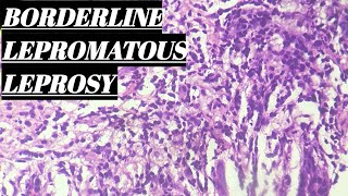 Borderline Lepromatous Leprosy Histopathology [upl. by Treulich586]