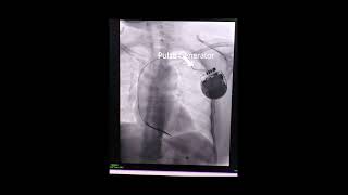 Automatic Implantable CardioverterDefibrillator AICD [upl. by Leahkim]