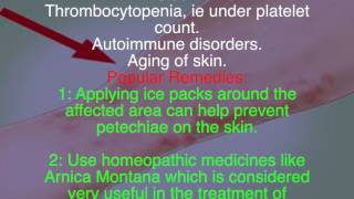 What are petechiae Remedies for petechiae [upl. by Eniotna512]