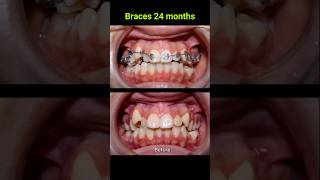 Braces correct all cases of crooked teeth braces orthodontist bracket [upl. by Bhayani]