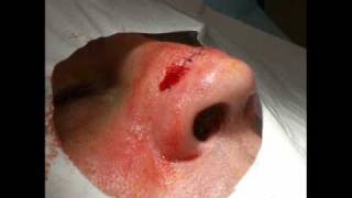 Surgery on the Nose for Squamous Cell Carcinoma [upl. by Anniken]