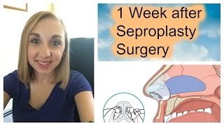 1 Week After Septoplasty Surgery [upl. by Soirtimid]