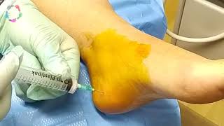 Painfree steroid injection by Podiatrist in UK for plantarfasciitis  heel pain [upl. by Lydell]