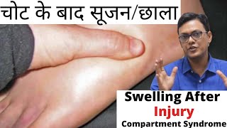 Swelling After Injury  चोट के बाद सूजनछाला   चोट की सूजन  COMPARTMENT SYNDROME [upl. by Aloisia291]