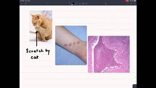 Stellate granuloma in CAT SCRATCH DISEASE [upl. by Assilav]