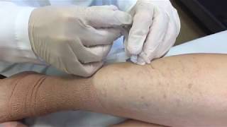 Varicose Vein Treatment  George Anton MD [upl. by Sprung]