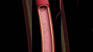 Atherosclerosis The Silent BuildUp [upl. by Ddahc622]