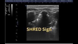 Shred Sign on Lung Ultrasound  Point of Care Ultrasound  Short Video [upl. by Eemia]