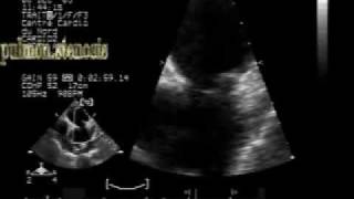 pulmonary stenosis  2D echo with zooming [upl. by Anilehs622]