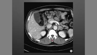 Suprarrenales Incidentaloma [upl. by Dnalor]