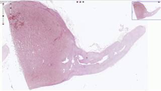 Pheochromocytoma  Histopathology [upl. by Adiehsar]