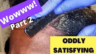 Oddly Satisfying Insane Dandruff Scratching Flakes Scalp Condition Removal After Braids Pt 2 [upl. by Gillespie996]