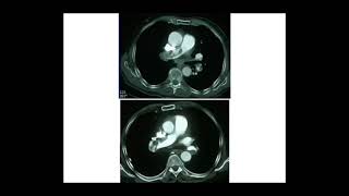 EMBOLIE PULMONAIRE Pr M METAHRI [upl. by Gilchrist]