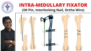 Intramedullary Fixation  Lecture 08  Orthopedics [upl. by Sami857]