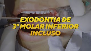 EXODONTIA DE TERCEIRO MOLAR INCLUSO  CIRURGIA [upl. by Consuela]