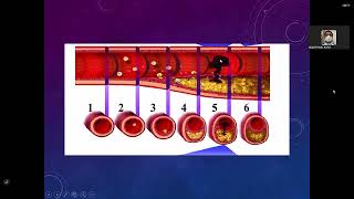 11 Cardiopatía Isquémica II Enf Coronaria Crónica [upl. by Leilamag412]