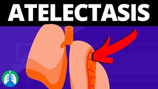 Atelectasis Medical Definition  Quick Explainer Video [upl. by Dj952]