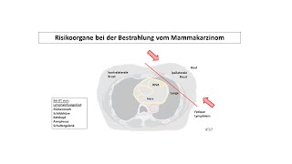 Risikoorgane bei der Bestrahlung vom Mammakarzinom  Strahlentherapie Prof Hilke Vorwerk [upl. by Vanhook466]