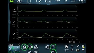 Vent Modes 101 Focus on the Waveform  BAVLS [upl. by Ydarg926]