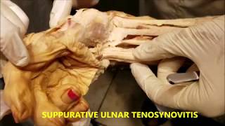 WRIST CARPAL TUNNEL Boundaries Contents SYNDROME and TSYNOVITIS – Sanjoy Sanyal [upl. by Hubert303]