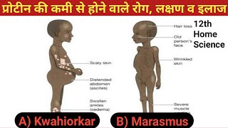 प्रोटीन की कमी से होने वाले रोग लक्षण व इलाज  Kwashiorkor disease  Marasmus disease [upl. by Mount892]