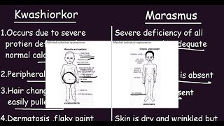 Kwashiorkor vs Marasmus Quick Differences amp Comparison [upl. by Ennaj]