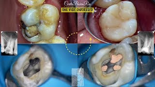 endodontic treatment continuous wave obturation warm lateral palfique super low [upl. by Idaf]