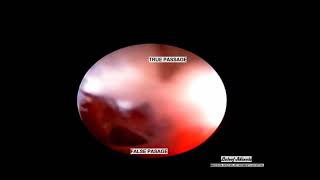 Severe cervical stenosis hysteroscopic adhesiolysis using ultrasound scan guidance [upl. by Renick]